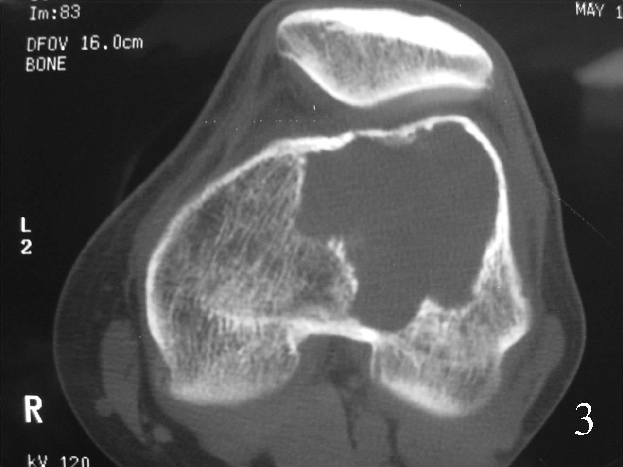 Giant Cell Tumor Of Bone Bone Tumors